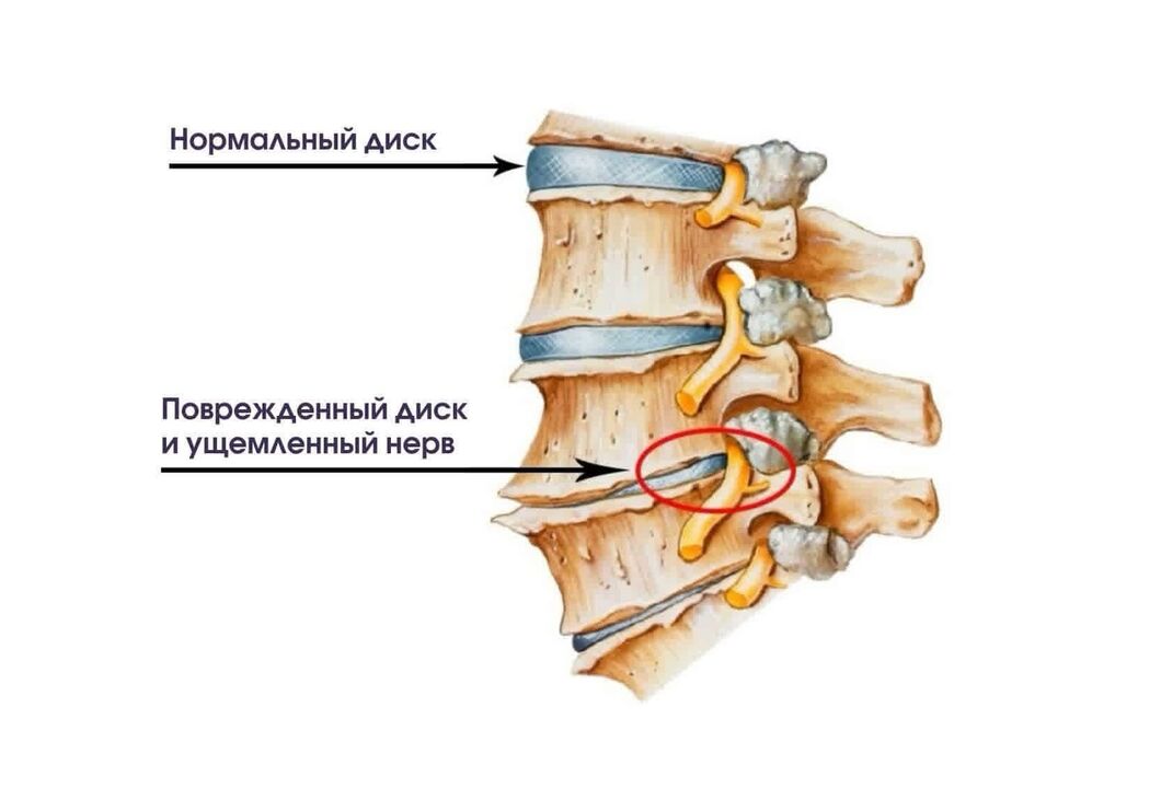 Симптоми на цервикална остеохондроза