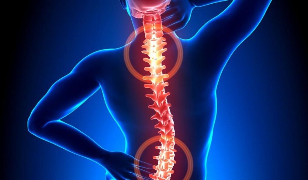 гръбначна остеохондроза