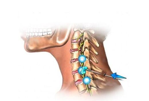 лечение на цервикална остеохондроза